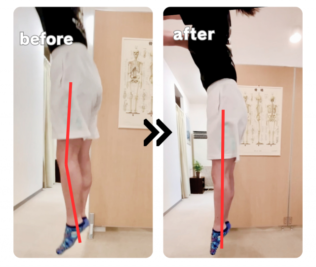 前十字靭帯断裂・半月板損傷の術後の不安定感改善の症例