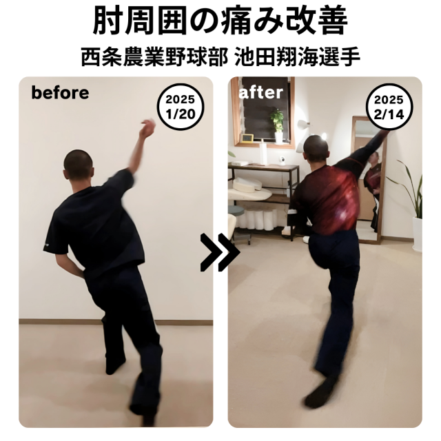 ケガで約2年間、まともに投げれなかったピッチャーの症例