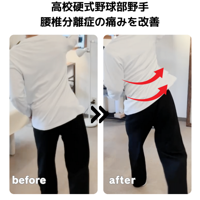 腰椎分離症の痛みの改善症例