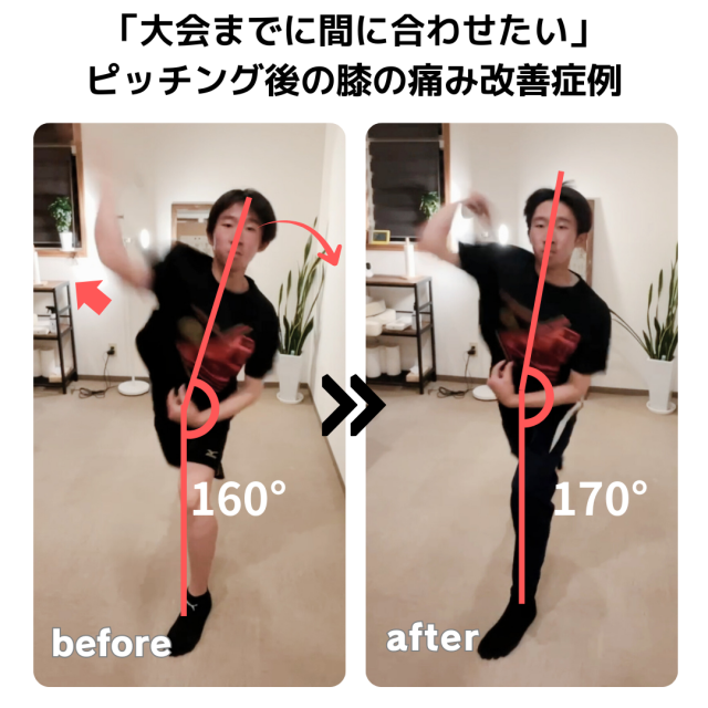 投球後の肘のズキッとした痛み改善症例