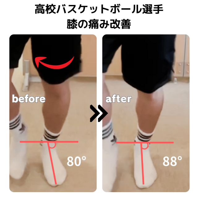 ジャンパー膝の痛み改善症例（高校バスケ部）