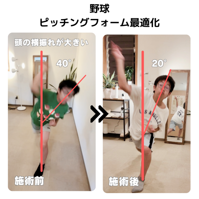 20球以上投げると肩が痛くなる症例