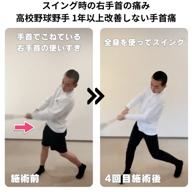 1年以上改善しないバットスイング時の手首の痛みの症例